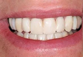 Galería de Sonrisas | Dentista Cosmético en Melbourne, FL | Dr. Victor Apel