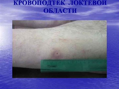 СУДЕБНО-МЕДИЦИНСКАЯ ТРАВМАТОЛОГИЯ ТРАВМА ТУПЫМИ И ОСТРЫМИ ПРЕДМЕТАМИ ...