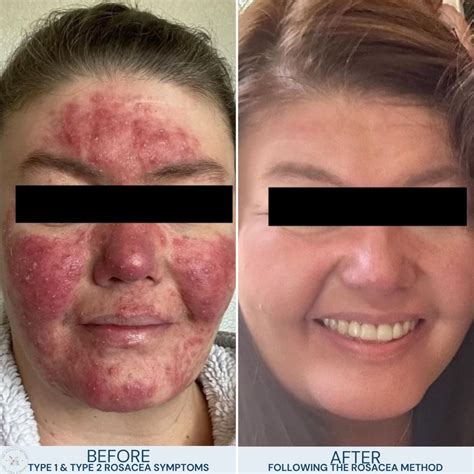 type  papulopustular rosacea  acne challenge  rosacea method