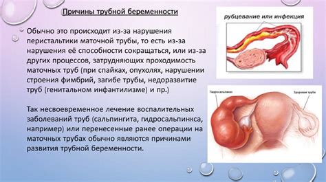 Внематочная беременность - презентация онлайн