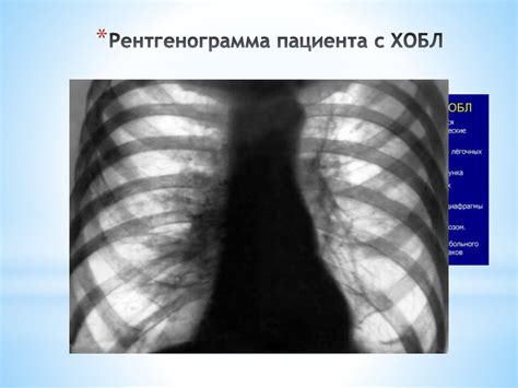 Хроническая обструктивная болезнь легких - презентация онлайн