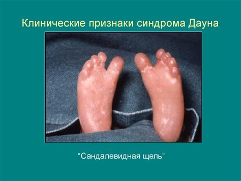 Хромосомные болезни - презентация онлайн