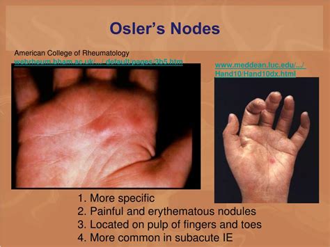 PPT - CARDIAC INFECTIONS PowerPoint Presentation, free download - ID ...