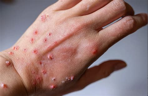 davao de oro implements preventive strategies  mpox philippine