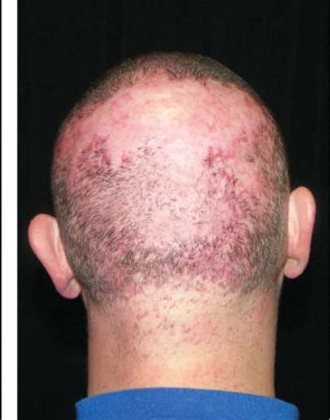 Chronic Scalp Folliculitis