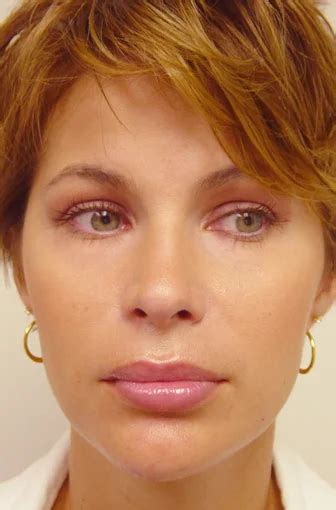 lip implants   pictures realself lip implants