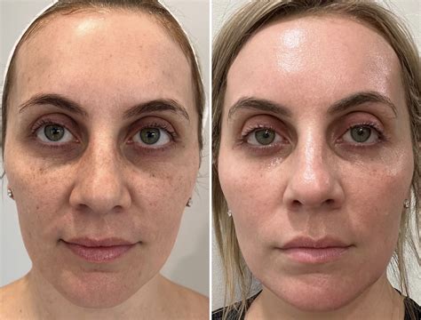 Laser Facial Phoenix at Leo Bunker blog