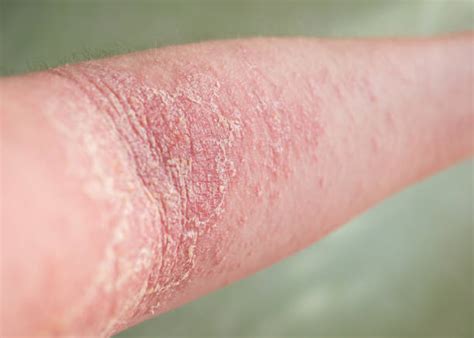atopic eczema foto stok potret gambar bebas royalti istock