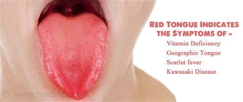 Learn What Your Tongue Says Your General Health