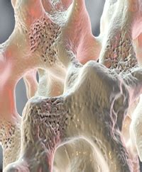 topic osteoporosis  bone diseases  real truth  health