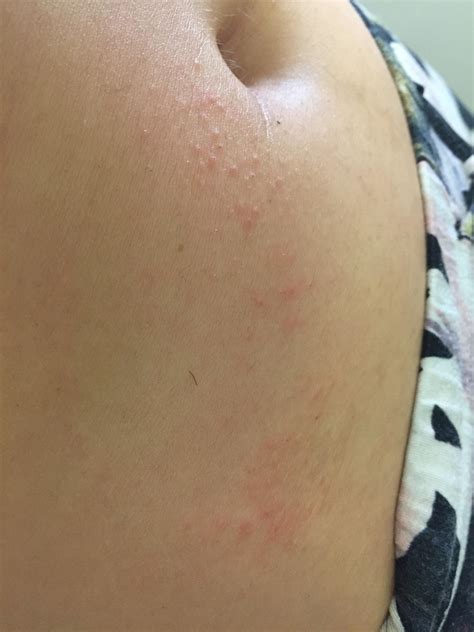 Is this follicular eczema or fungal related? : r/DermatologyQuestions