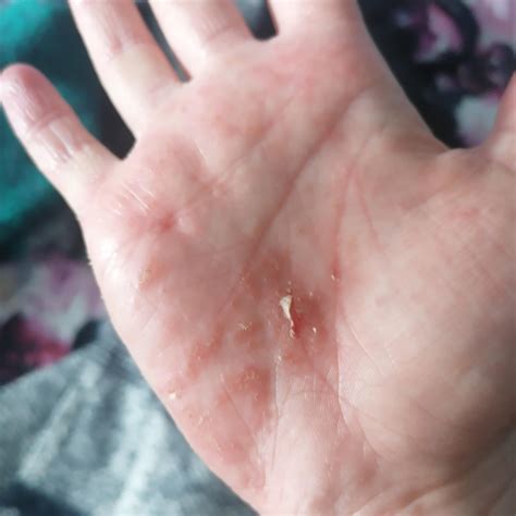 I couldn't help myself.. One itchy palm and one available zip on a bag