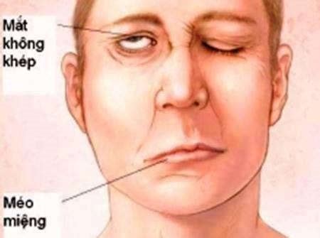 học Y: Phân biệt liệt VII trung ương và ngoại biên