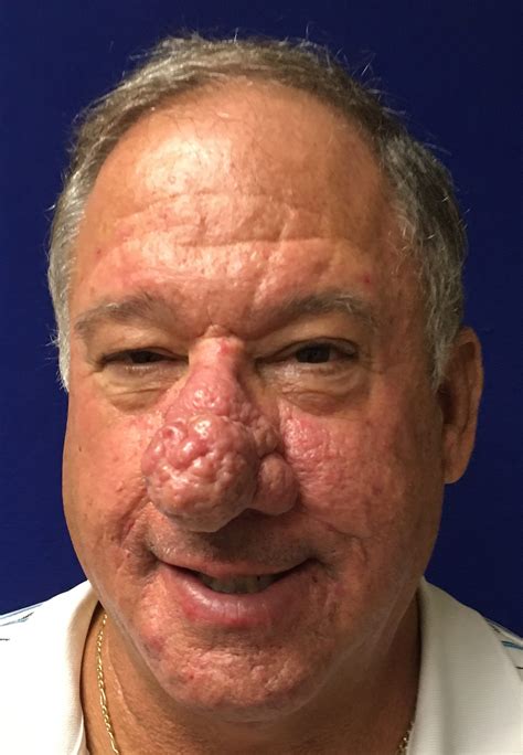 Pre and Post Rhinophyma contouring - Midwest Sinus and Allergy