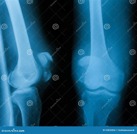 Knee Ap Lat 6