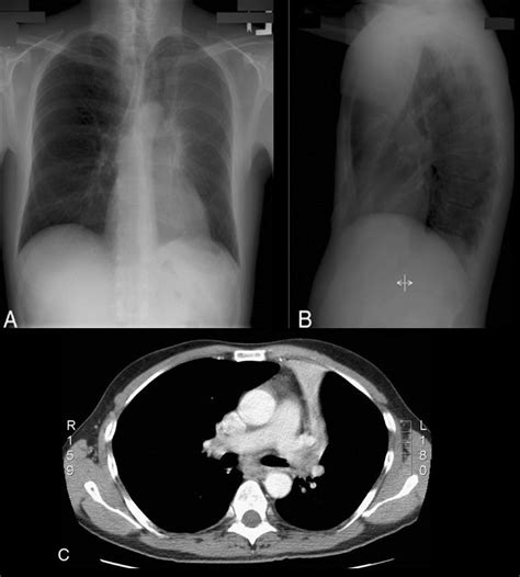 Luftsichel sign | Lungs