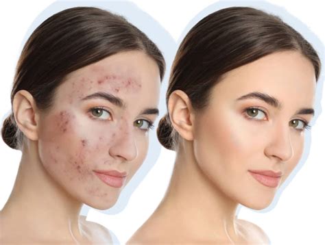 Chemical Peel in Richmond Hill & Toronto - Donya Medical Spa