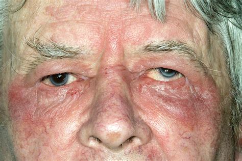 Eczema around the eye - Stock Image - C023/0703 - Science Photo Library