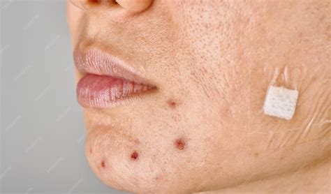 whitehead skin