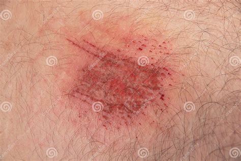 abrasion wound  caucasian skin close  stock image image  human