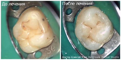 Хорошая пломба или нет: как понять?