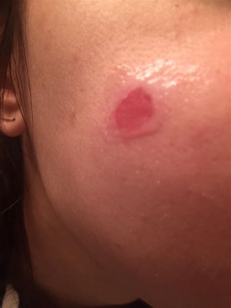 Serous Fluid Pimple