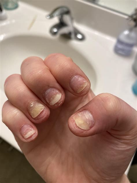 My recovery from Onycholysis : r/Nails