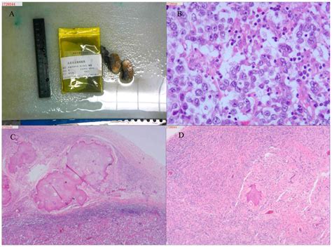 True hermaphroditism with seminoma: A case report