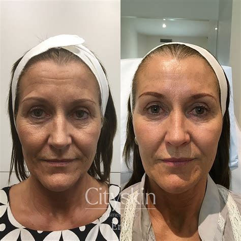 Textbook Of Facial Rejuvenation The Art Of Minimally Invasive Combination Therapy 10
