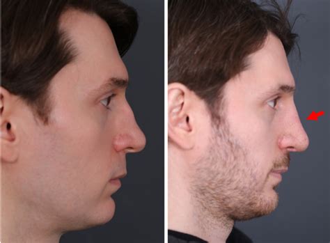 Use of The Diced Cartilage Glue Graft in Rhinoplasty - Rhinoplasty Archive