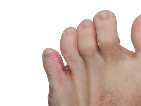 Foot Fungal Infection Blisters