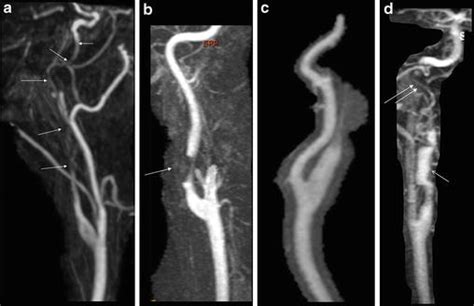 Carotid Artery Dissection | Radiology Key