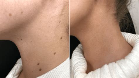 Mole Removal Healing and Recovery: Pictures & Aftercare