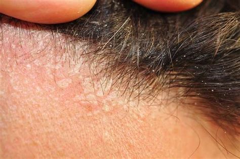 Dermatitis Seboroik Kepala, Kenali Penyebab, Gejala, dan Cara ...