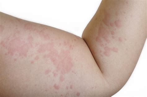 Causes skin rashes that itch - teresite