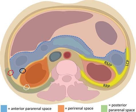 radiologic pathologic correlation  primary retroperitoneal