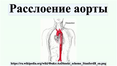 Расслоение аорты - YouTube