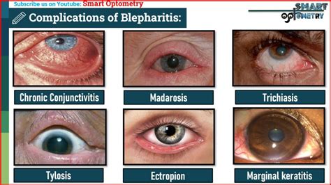 blepharitis introduction  symptoms signs treatment