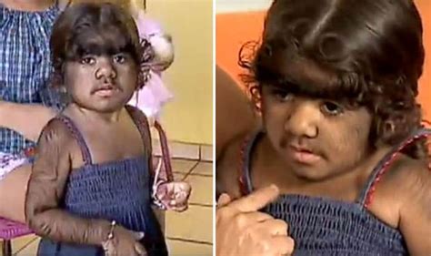 Little girl with WEREWOLF syndrome stops receiving treatment because ...