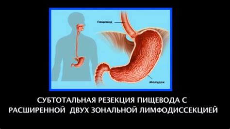 Операция. Субтотальная резекция пищевода с расширенной двух зональной ...