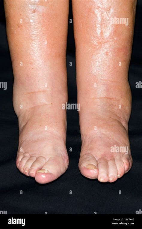 oedema swelling   ankles   legs   adult female patient