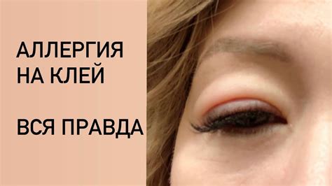 Наращивание ресниц.АЛЛЕРГИЯ НА КЛЕЙ.Что делать.ВСЯ ПРАВДА! - YouTube