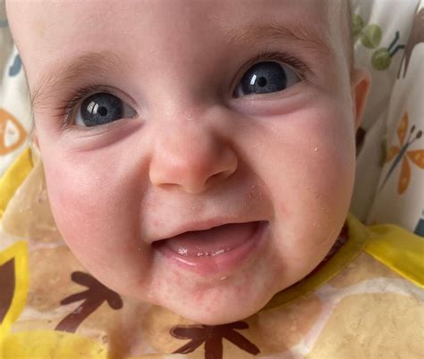 Dribble/teething rash?? | BabyCentre