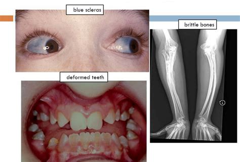 Osteogenesis Imperfecta X Ray