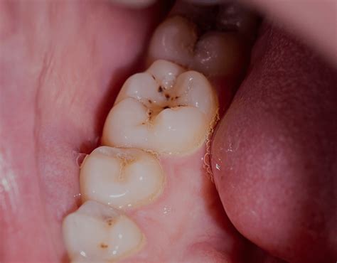 black stains  teeth  treatment   natrusmile
