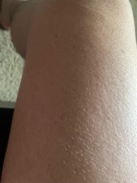 Red spots on thighs : r/medical_advice