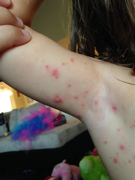A Journey With The Jones': Impetigo Round #2