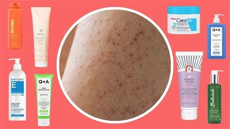 Best keratosis pilaris treatment I’ve tried UK 2024