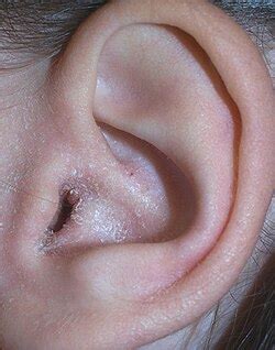 ear eczema wikipedia