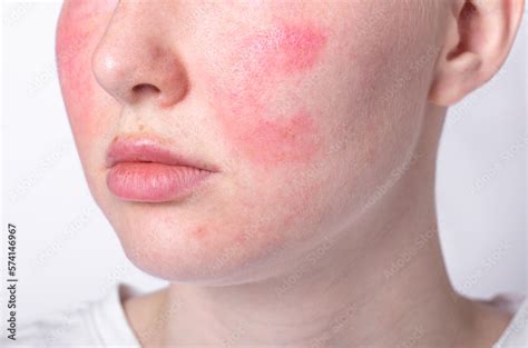 rosacea couperose redness skin, red spots on cheeks, young woman with ...